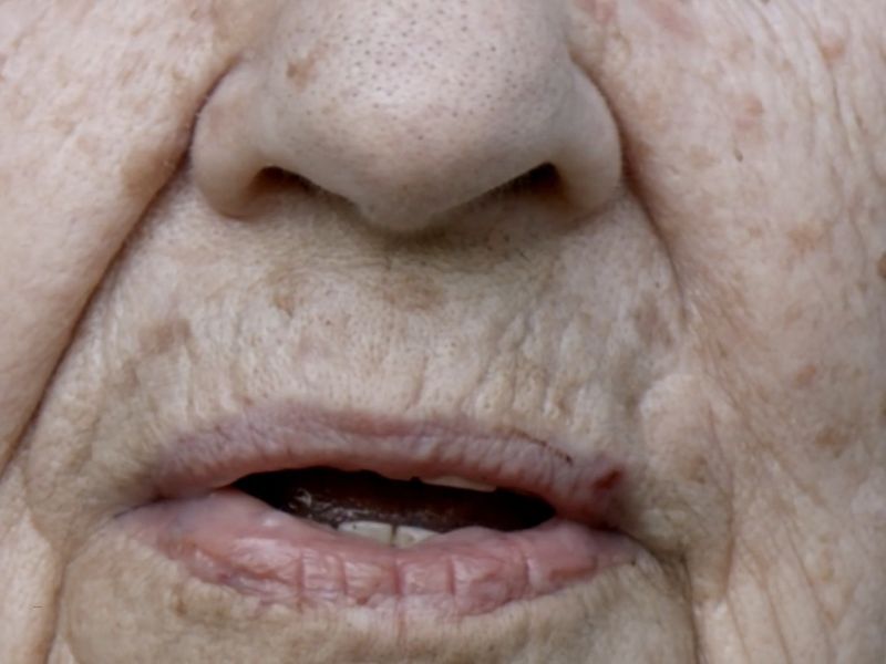 prikaz fleka kod starijih osoba na licu