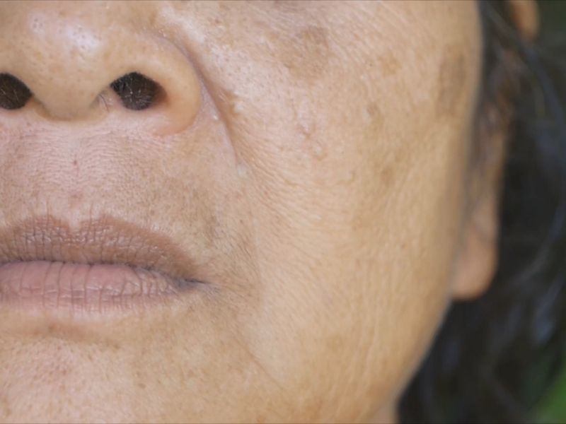 staračke fleke na licu